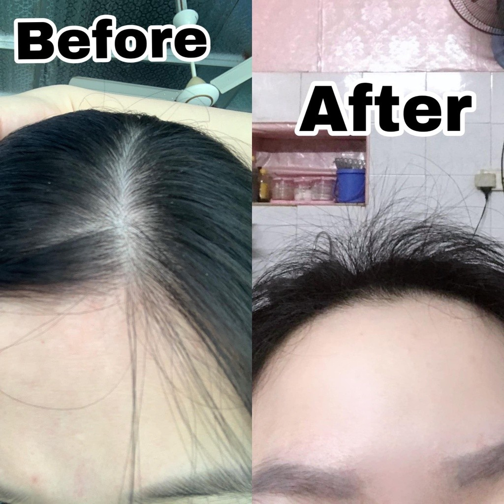 Xịt mọc tóc Minoxidil Bailleul 2%, 5% - NHẬP TRỰC TIẾP PHÁP - NGĂN RỤNG TÓC, KÍCH THÍCH MỌC TÓC 1 lọ lẻ